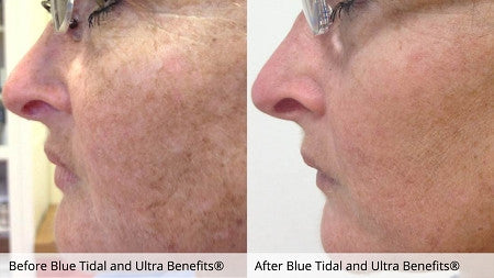 Before and after 6 Blue Tidal Enzyme Treatments and daily use of Ultra Benefits