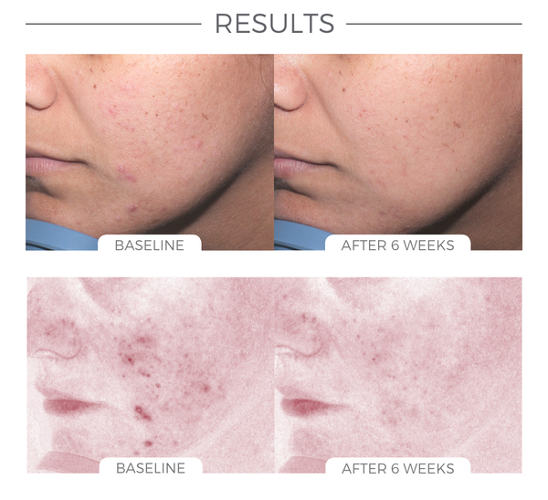 ACNE CONTROL SYSTEM before and after results