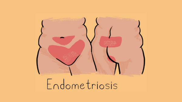 Endometriosis illustration