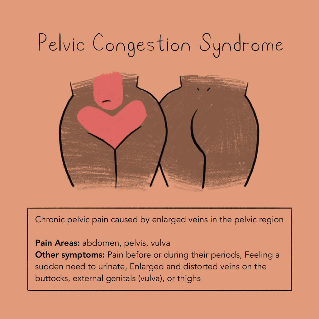 Pelvic Congestion Syndrome Momotaro Apotheca