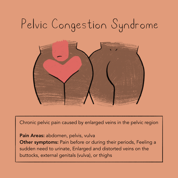 Pelvic Congestion Syndrome – Momotaro Apotheca