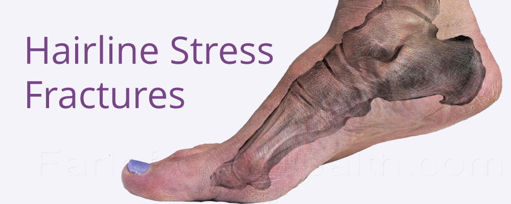 How to Treat Hairline Stress Fractures in Foot Bones