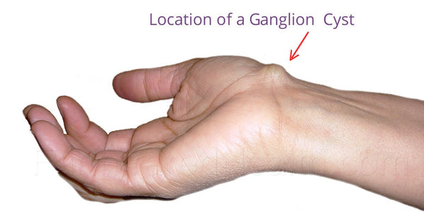 Common Location of a Ganglion Cyst on a Wrist.
