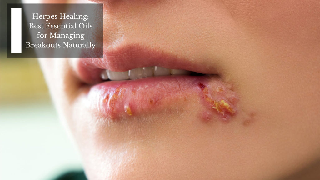Herpes Healing: Best Essential Oils for Managing Breakouts Naturally