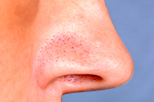 What Causes Nose Blackheads Causes And Treatment And Tiege Hanley 