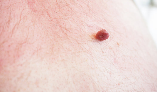 pics of cancerous skin tags