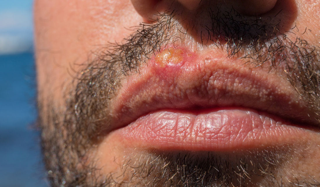 5 Tips To Treating Sun Blisters On Lips And Tiege Hanley 