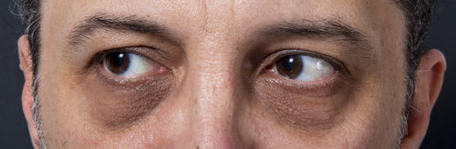 closeup of dark rings around eyes