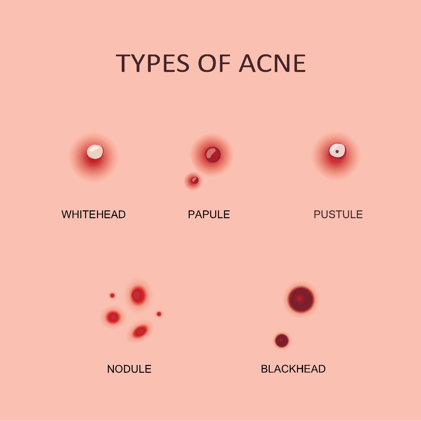 List 98+ Images Types Of Acne With Pictures Updated 12/2023