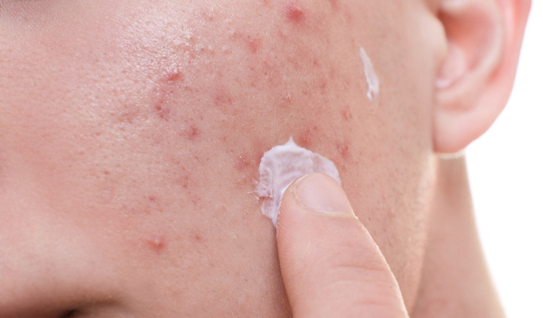 man applying cream problem skin