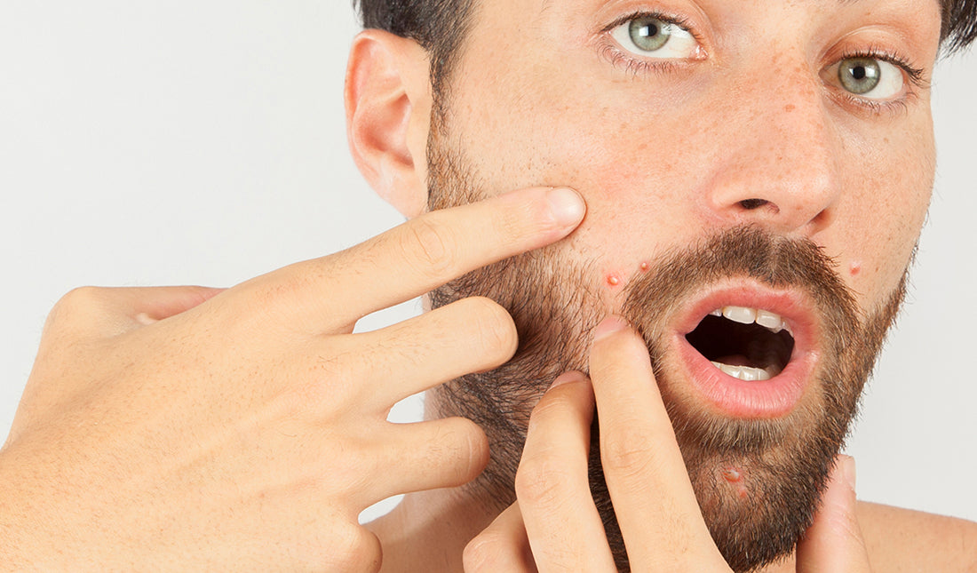 man raakt gezicht aan met acne rond mond