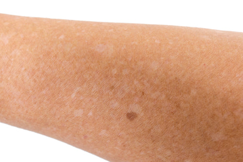 How To Get Rid Of White Spots On Arms