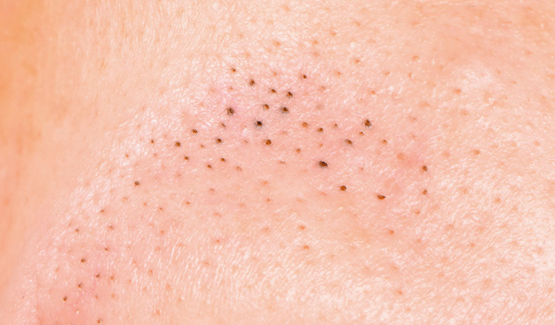 zoom in to pores with blackheads