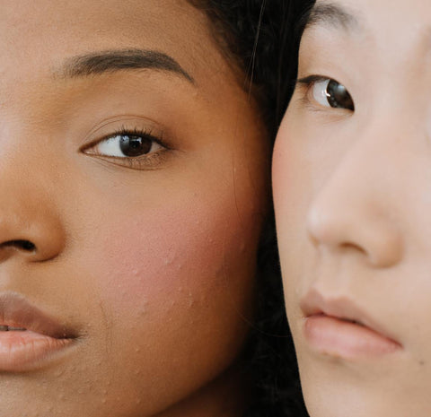 Two women face to face one with acne