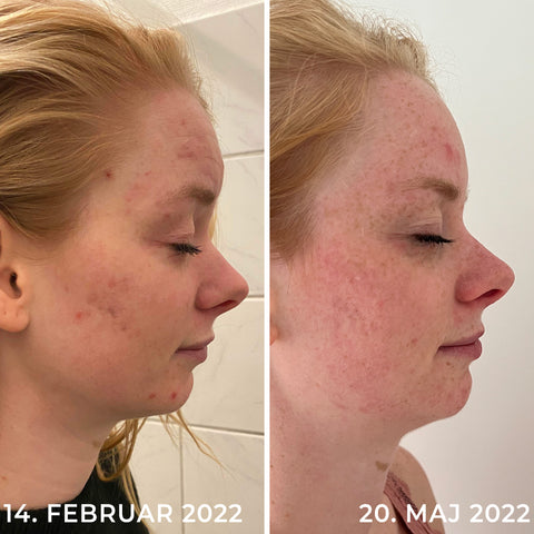 Før og efter billede af Anti-Aging Face Cream fra Sanzi Beauty