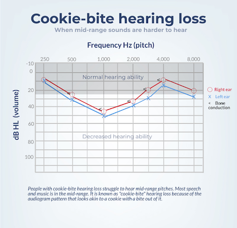 Cookie Bite Audiogram