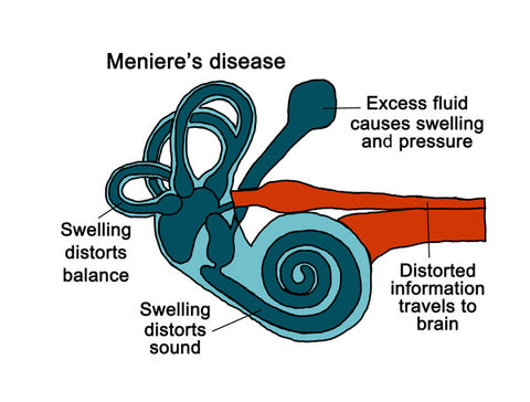 Inner Ear with Meniere Disease