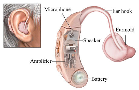 What are Hearing Aids