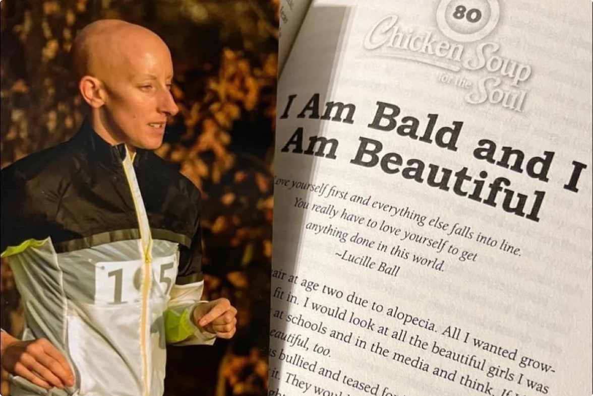 i am bald and i am beautiful canada