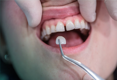 Veneers to fix gaps between teeth - NewSmile