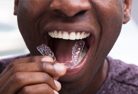 Man putting in a clear aligner | NewSmile®