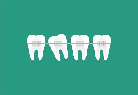 How to fix spacing in teeth from home | NewSmile™