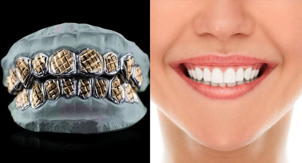 Grillz vs Veneers: Analyzing Aesthetics