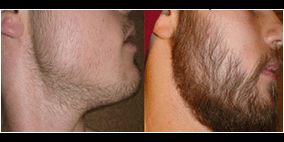 Вреден ли миноксидил для бороды