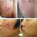 Acne Scar Removal Cream