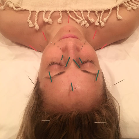 LAPS founder, Lauren, receiving facial acupuncture from Samantha