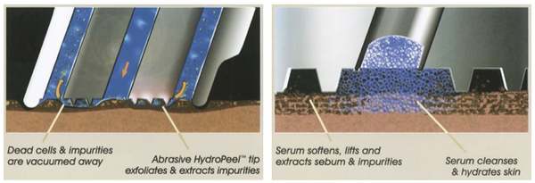 HydraFacial Process The CLINIC