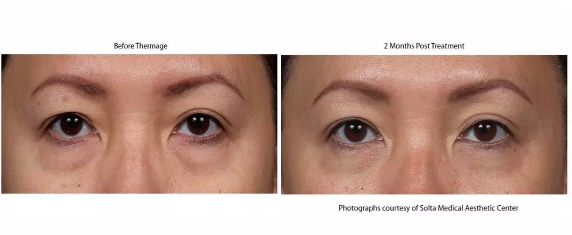 Thermage Eye Before & After