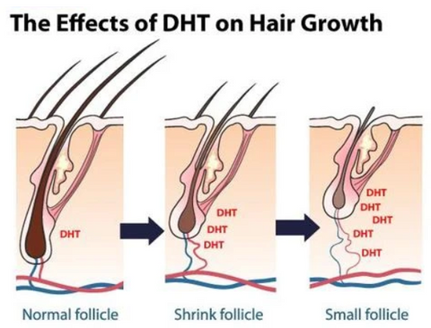DHT hormone hair loss  How to stop dht hair loss  Dihydrotestosterone  role in Baldness