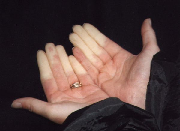 Raynaud's sufferers struggle to keep hands warm