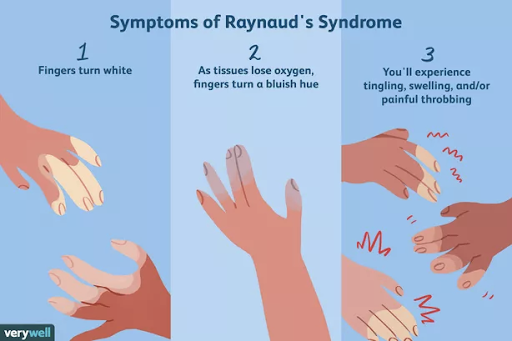 Raynaud's disease as it manifests in the hands