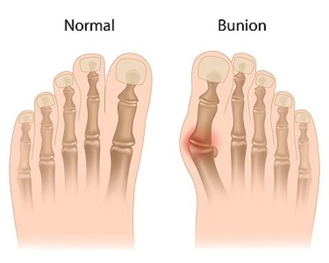 https://www.midtownfootcare.com/blogs/item/130-bunions-and-associated-problems