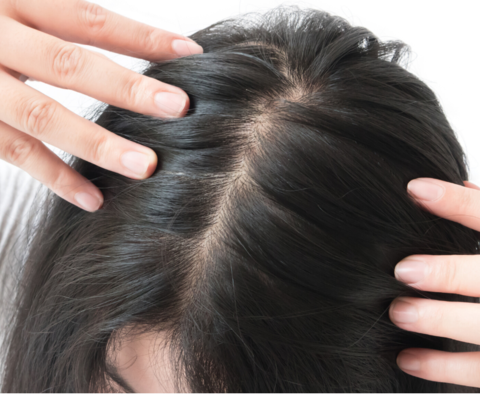 Treating women's hair loss with saw palmetto