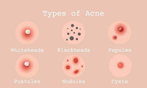 types of acne