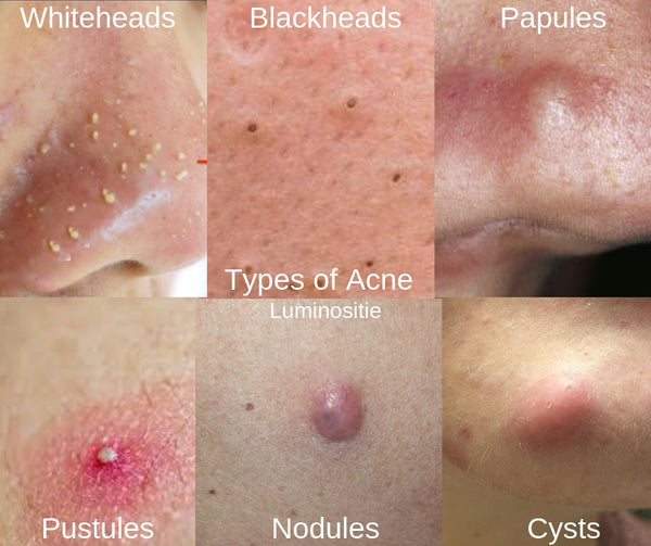 types of acne