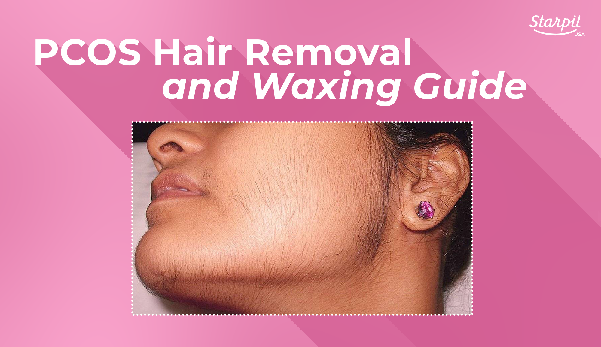 Hormonal Hair Growth  Permanent Removal  Real Styling Solutions