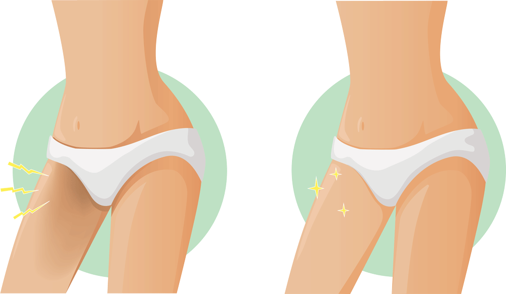 How to Lighten Bikini & Pubic Areas