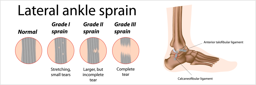 Ankle Sprains Causes Symptoms And Treatment Endurelite