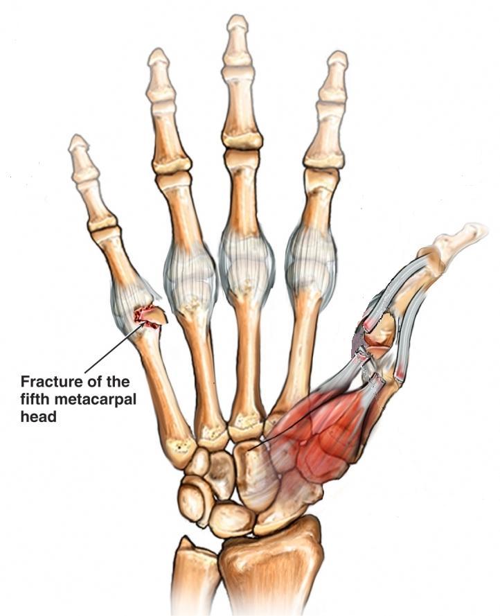 boxer fracture