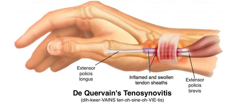 De Quervain's Tenosynovitis Symptoms, Diagnosis and Treatment ...