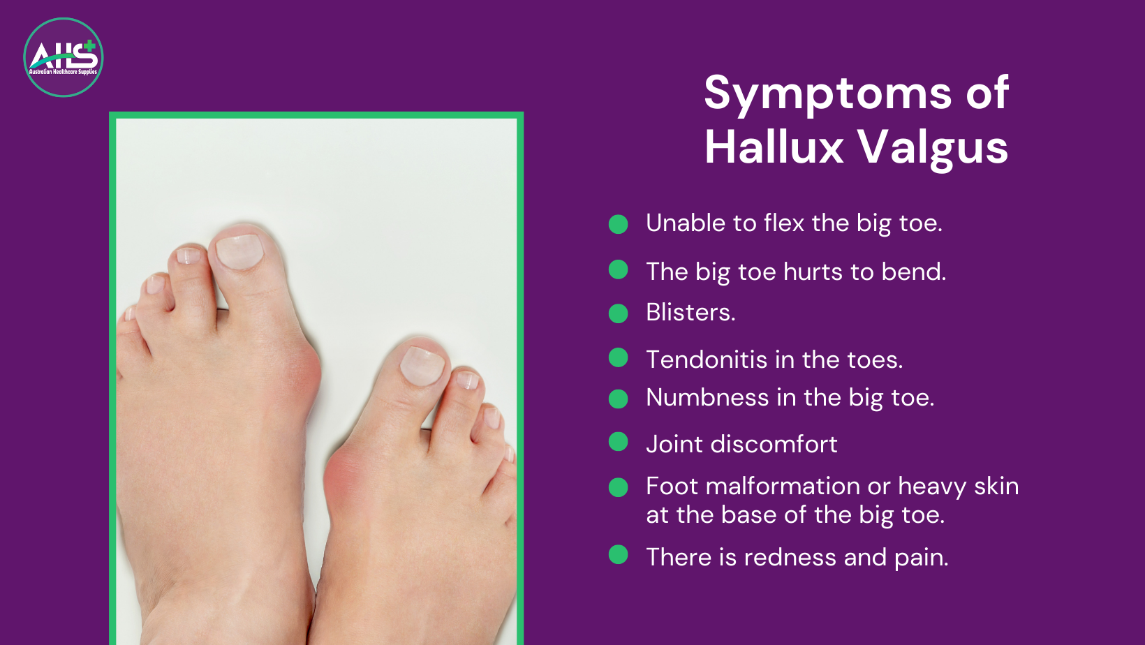 symptoms of hallux valgus