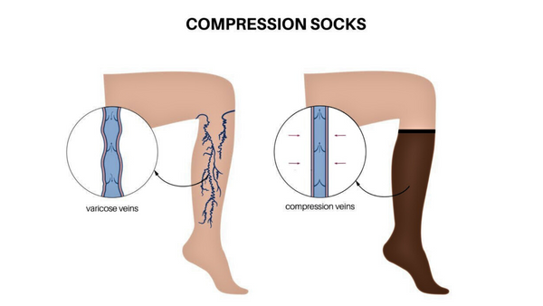 how varicose socks works