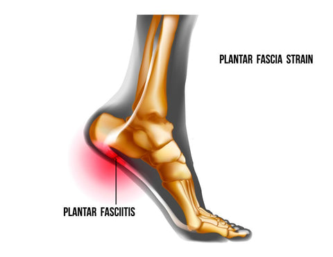 ankle fracture