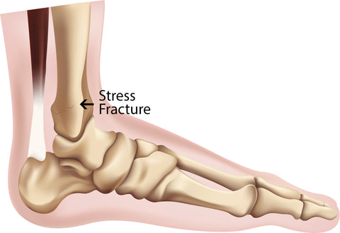 ankle sprain fractures