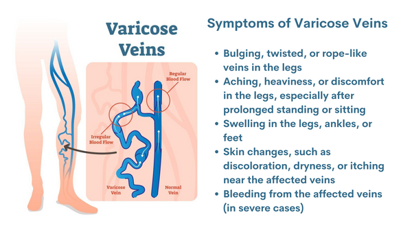 symptoms of varicose veins