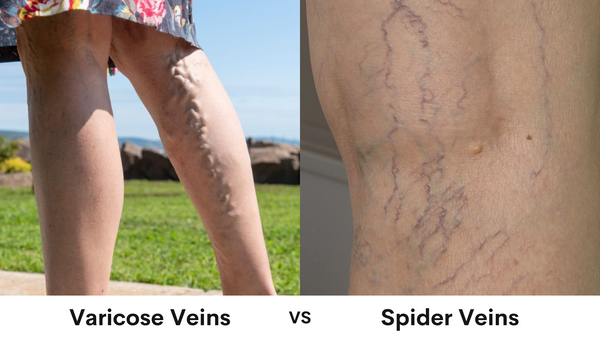 difference between varicose veins and spider veins